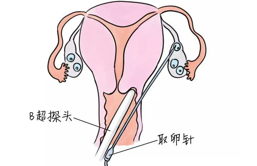 试管取卵